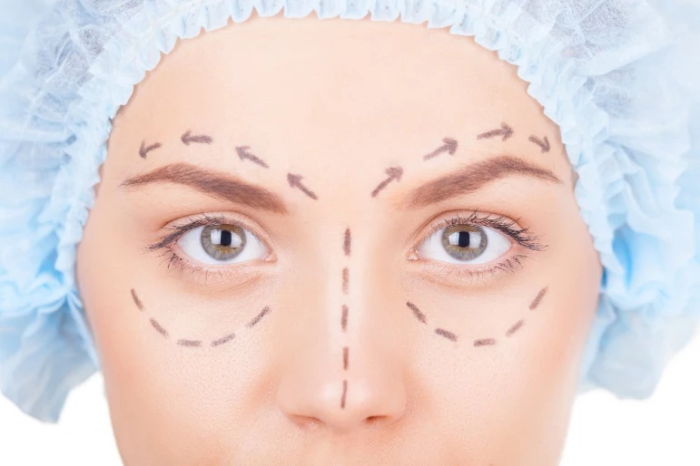 Blepharoplasty of the upper and lower eyelids - 2308 - photo 1